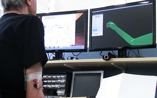 Phantom Limb Pain درمان درد فانتوم اندام